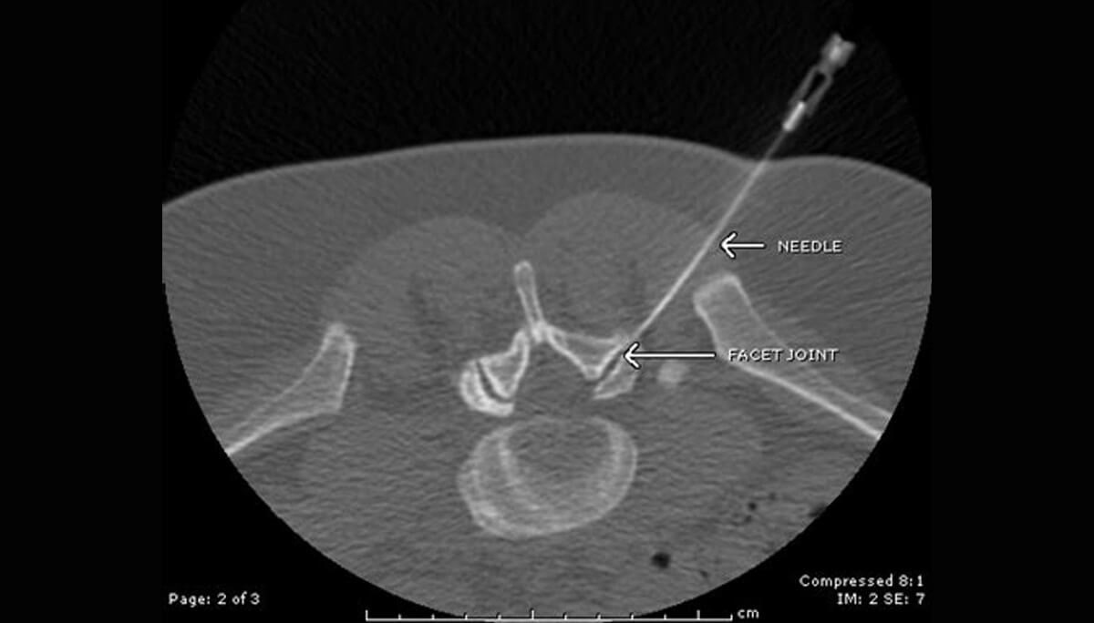 Infiltration - Iris Radiologie